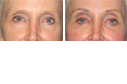 Before & After Photos